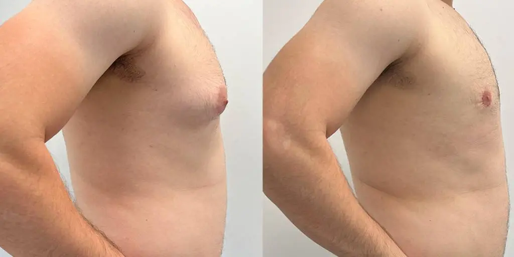 Male gynecomastia (gyno) after steroid use