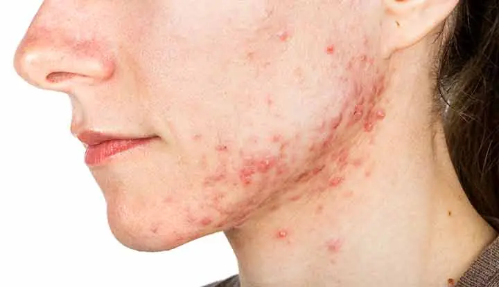 Acne breakout after steroid usage