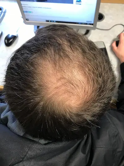 Male pattern hair loss showcase