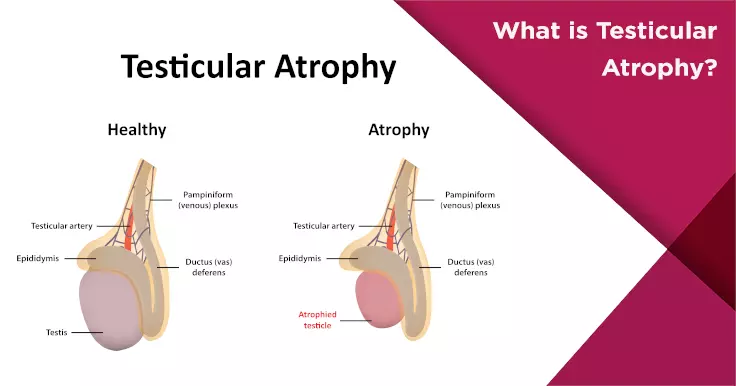 What is Testicular Atrophy